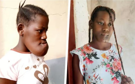 Olsztyńscy lekarze ponownie pomogą 17-letniej Cristinie z Angoli. Trwa zbiórka środków